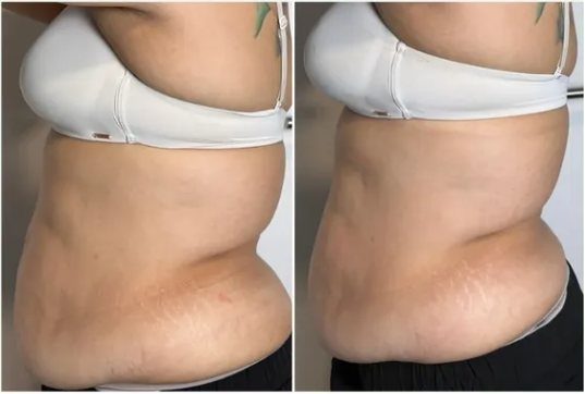 Resultado real de um tratamento Hifu corporal, antes e depois